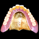 ゴールド鋳造床義歯