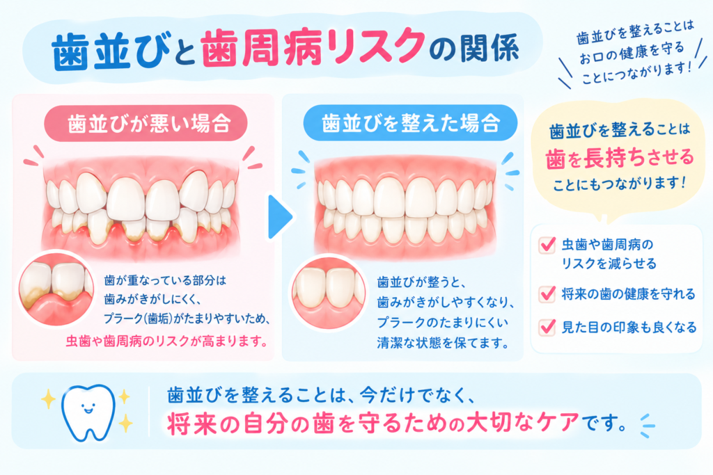 歯並びと歯周病リスクの関係を示す図解
