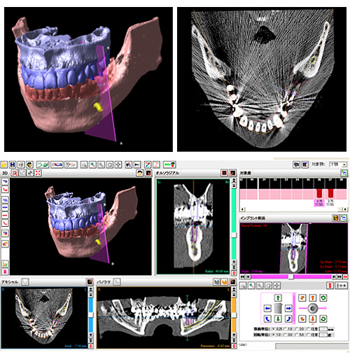歯科用CT（3Dレントゲン）
