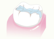 虫歯から歯を守るシーラント